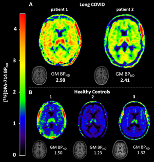 Petscan van 2 personen met longcovid en een controlegroep van 3 gezonden personen